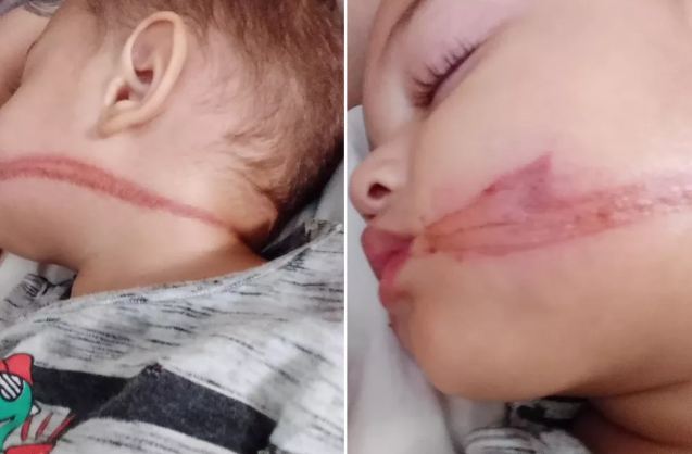 Bebês atingidos por fio: CPFL diz que notificou empresas responsáveis